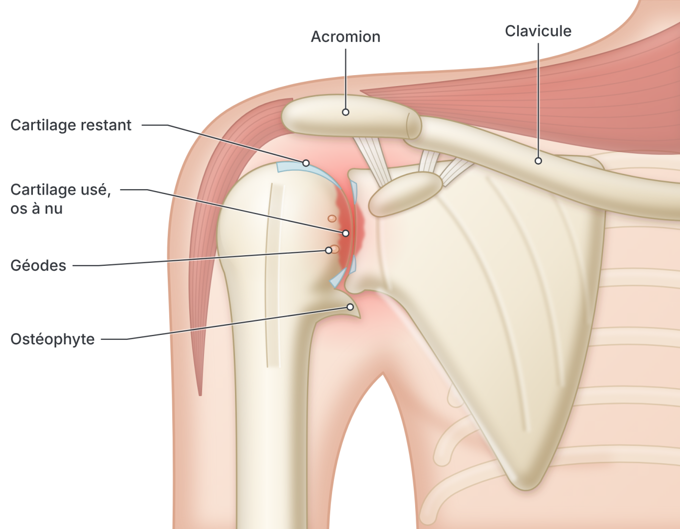 Schéma d'une arthrose de l'épaule (omarthrose)