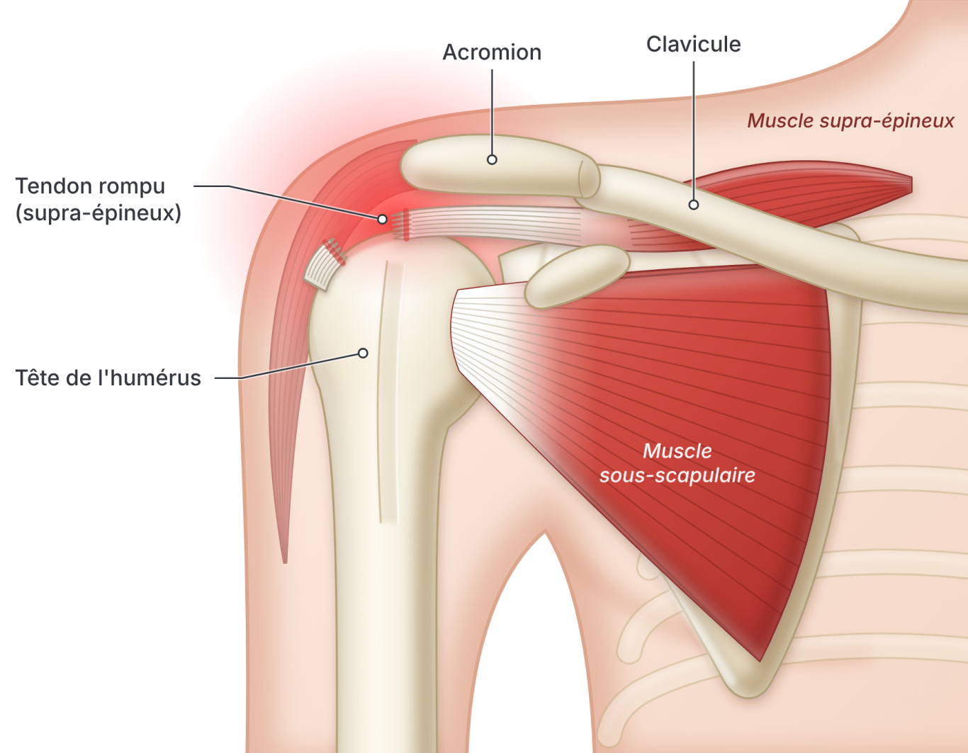 Illustration d'une rupture d'un tendon de la coiffe des rotateurs de l'épaule